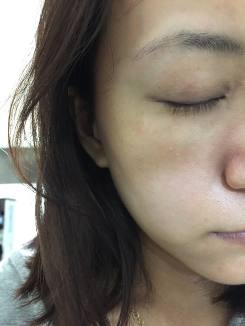 看过几家皮肤科 每家讲的都不一样,有过滤性病毒疣,有扁平疣,有黑色