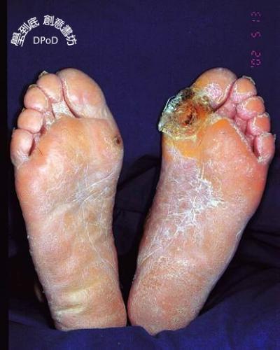糖尿病足部潰瘍